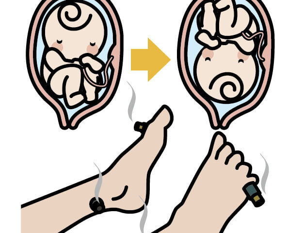 逆子でお悩みの方へ｜鍼灸による逆子治療について　大津市石山・瀬田　石山東洋鍼灸整骨院