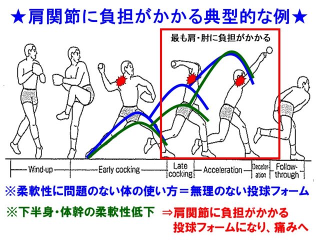 野球肩対策必見　大津市石山東洋鍼灸整骨院