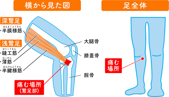 鵞足炎について　大津市石山東洋鍼灸整骨院