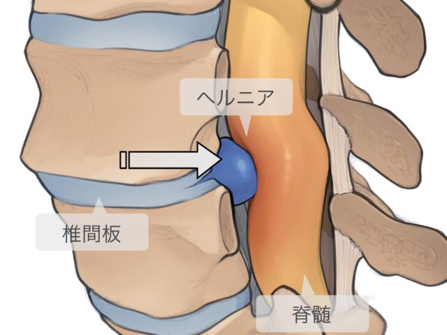 腰椎椎間板ヘルニア　大津市石山東洋鍼灸整骨院